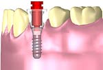 Zahnimplantate: Patienteninformation