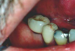 Die implantatgetragene Zahnkrone