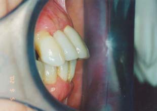 Parodontose-Behandlung: Der schwerwiegende Fall 